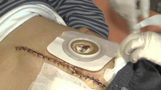 Stoma Bakımı Nasıl Yapılır?