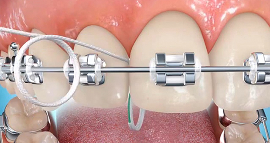 Diş Teli Bakımı Nasıl Yapılır?